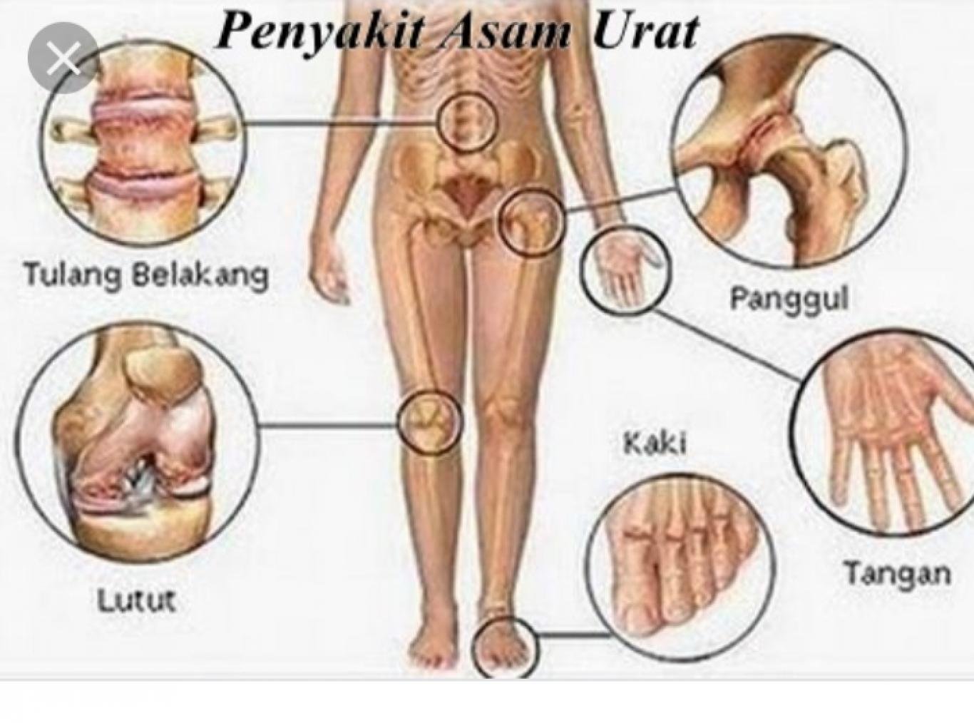 asam urat