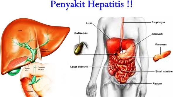 hepatitis